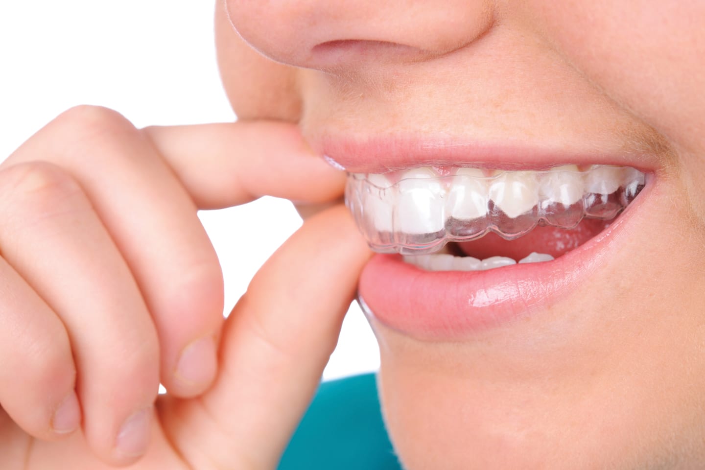 invisalign treatment orthodontic orthodontists orthodontist cabezon patients teeth rancho nm rio healthscopemag