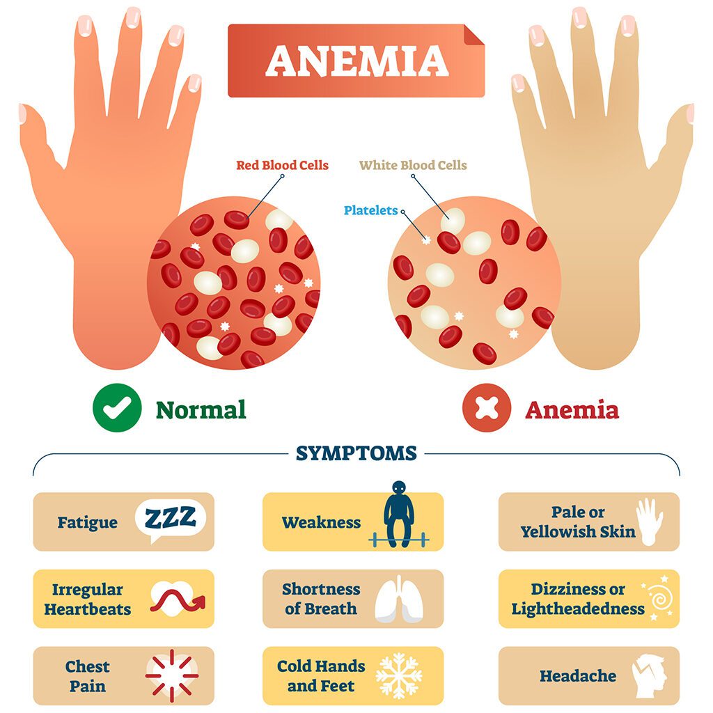 Iron deficiency anemia