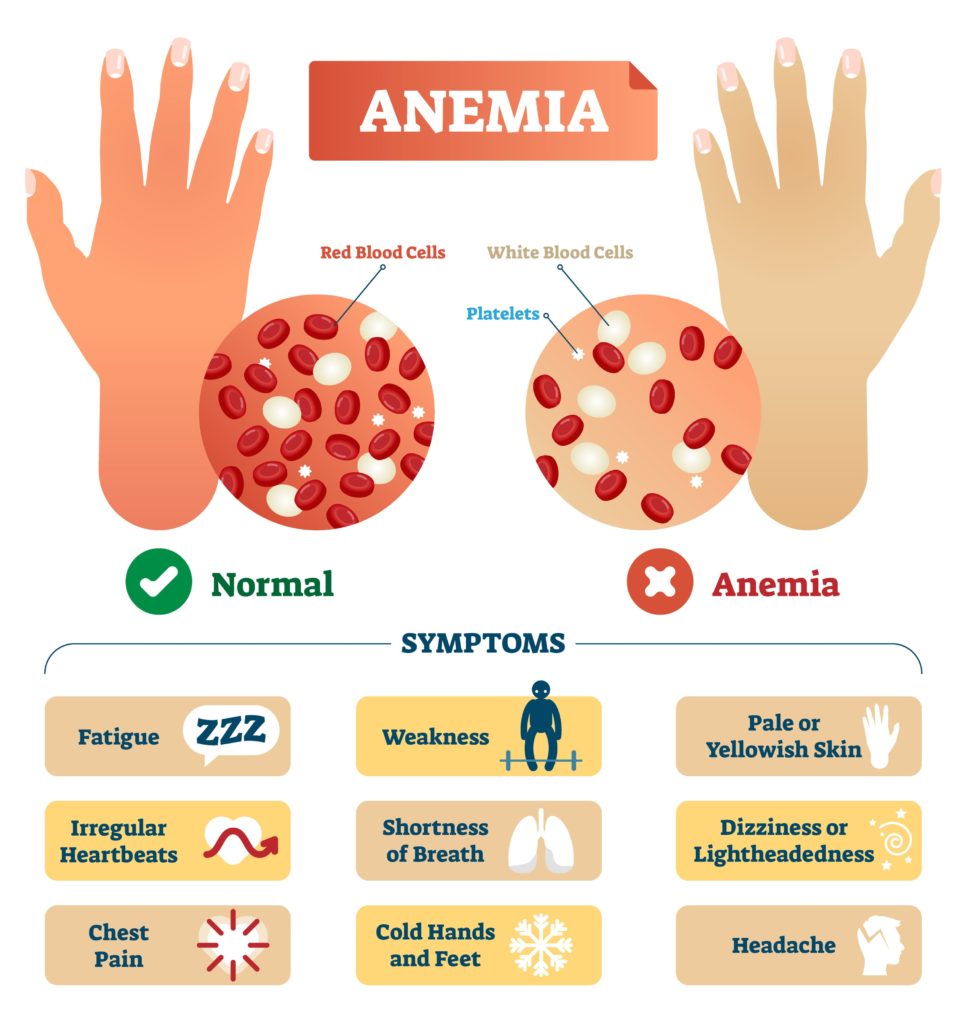 Anemia vector illustration. Medical labeled scheme with problematic red and white blood cells, and platelets. Microscopic diagram with disease diagnostic symptoms.