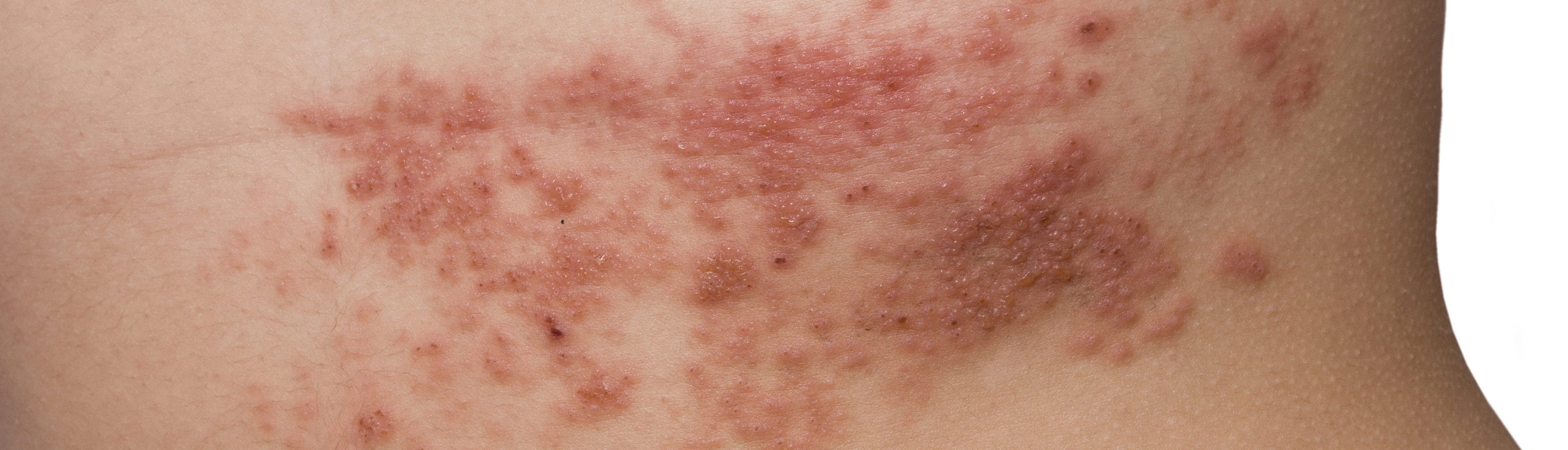 herpes zoster rash (shingles)