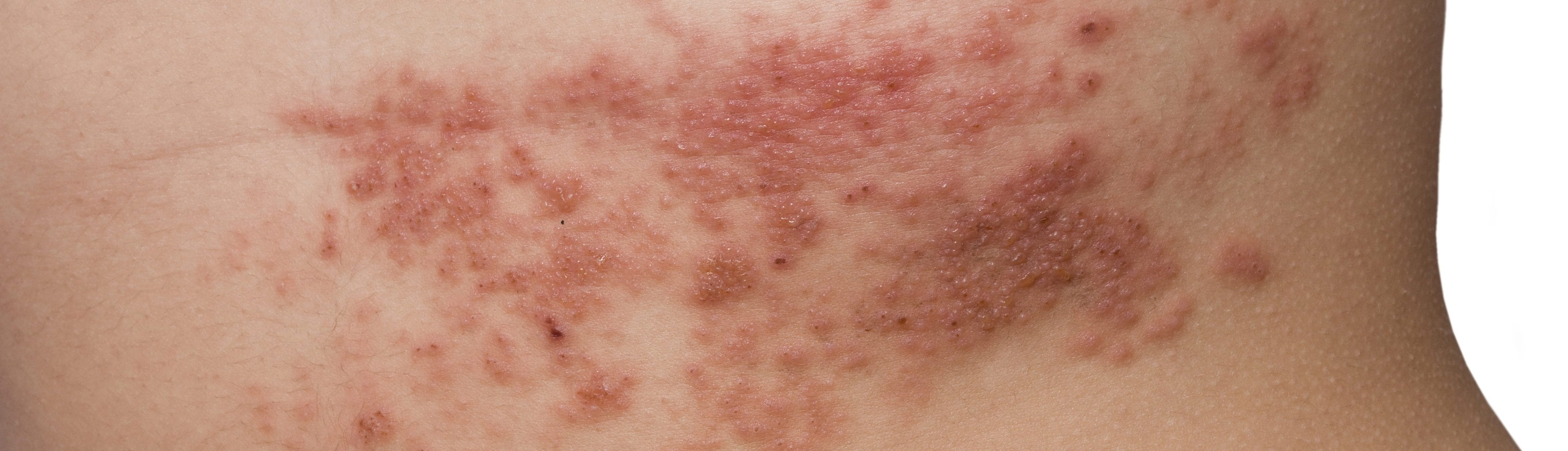 what-are-shingles-with-pictures-healthscope