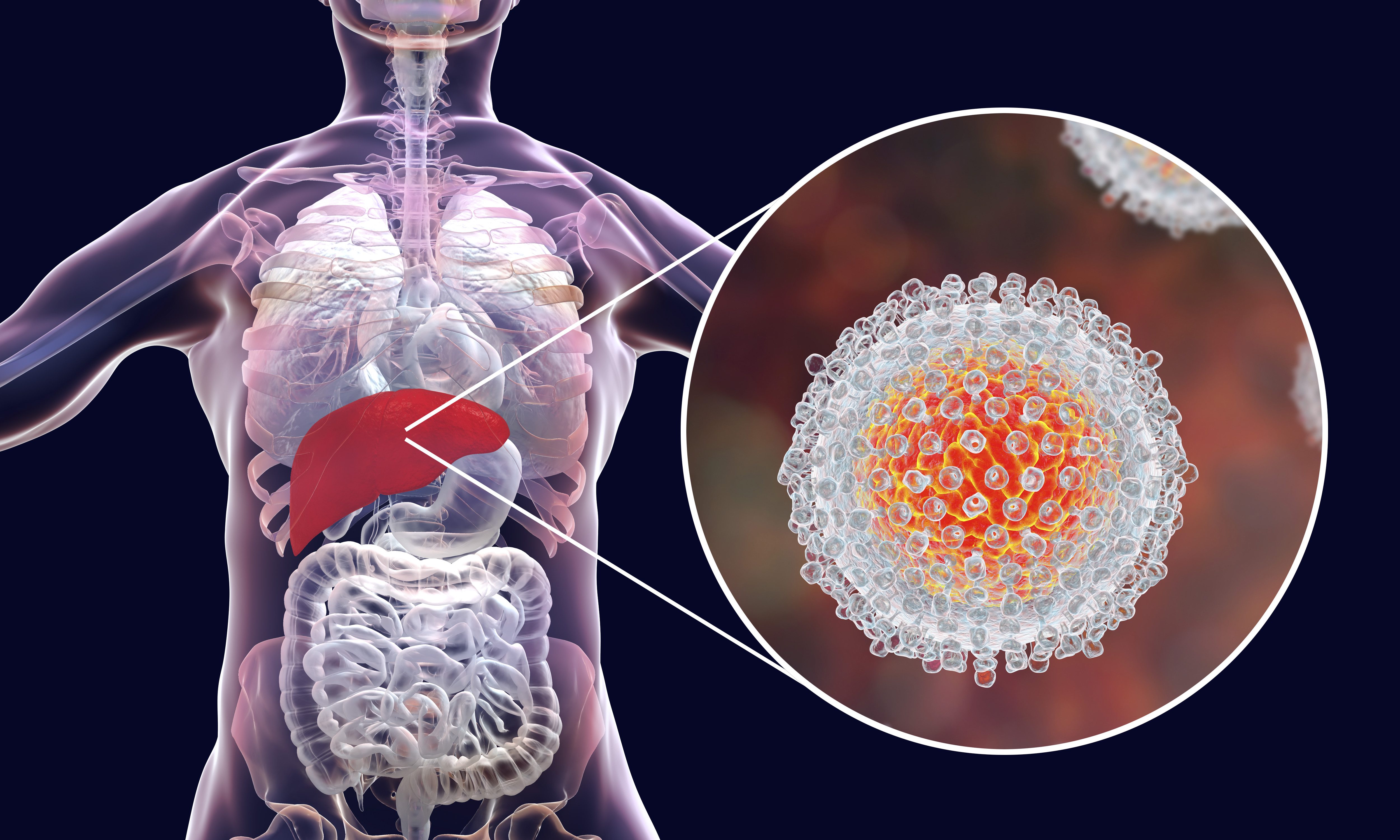 Hepatitis A Hepatitis S Ntomas Causas Y C Mo Tratar La Enfermedad