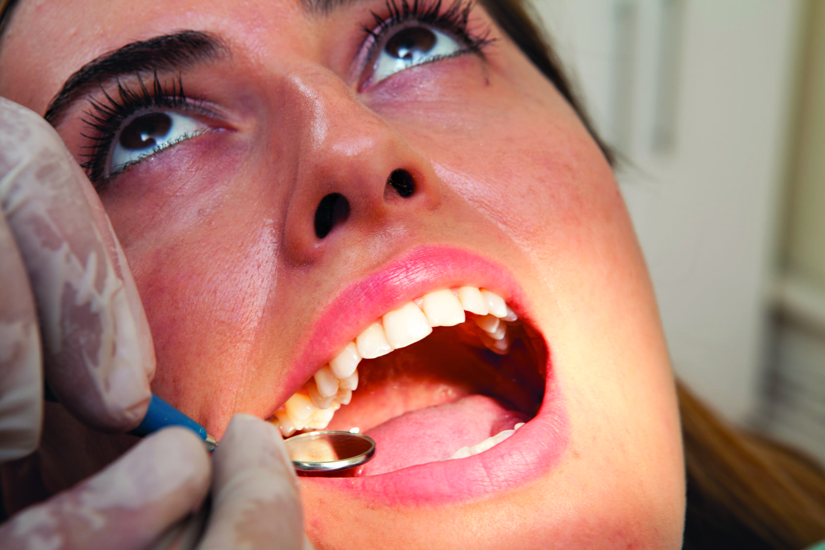 Wisdom Tooth Extraction - HealthScopeHealthScope