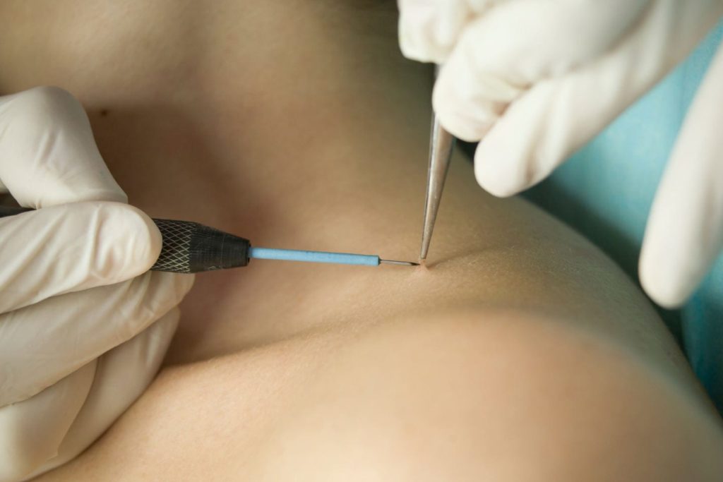 skin tag being removed