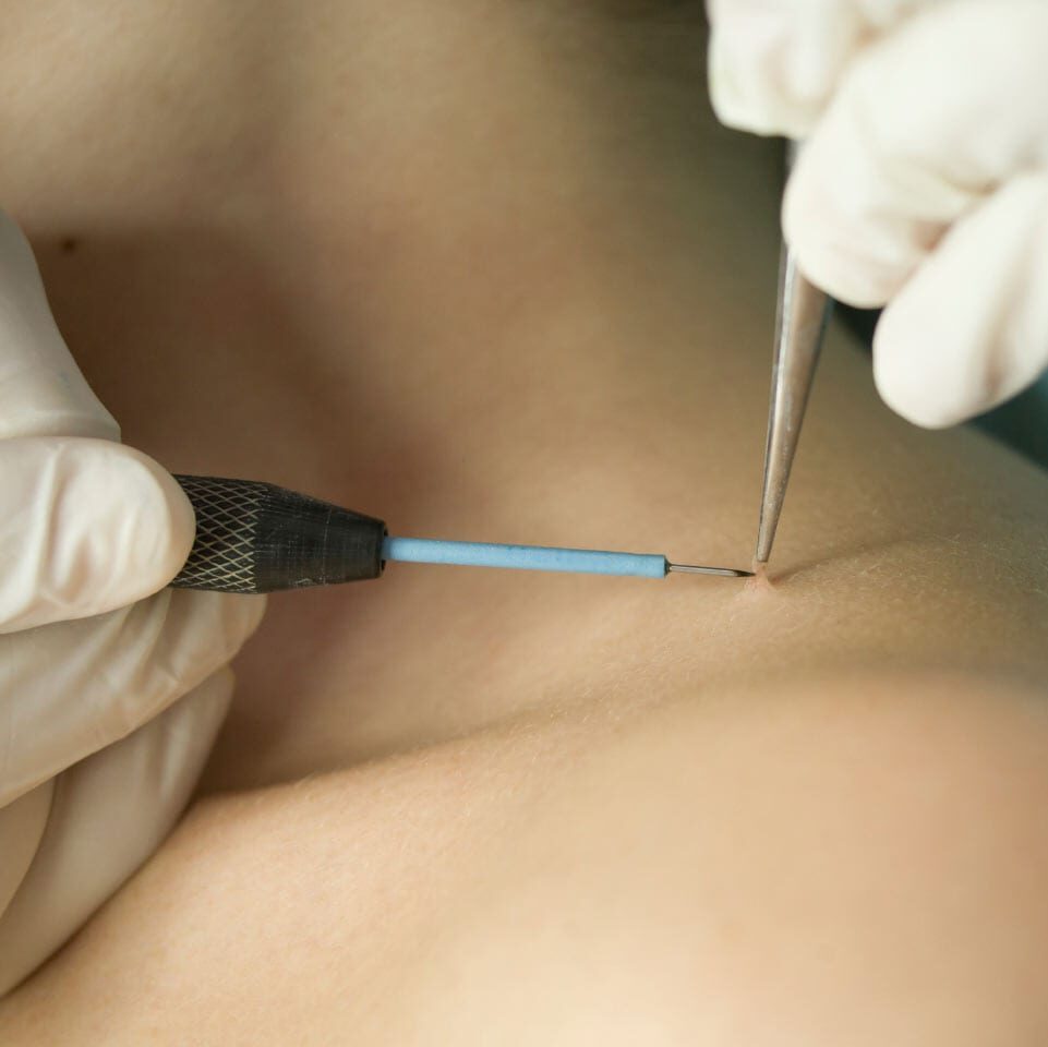 skin tag being removed