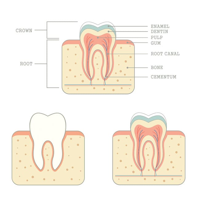 root-canals_1