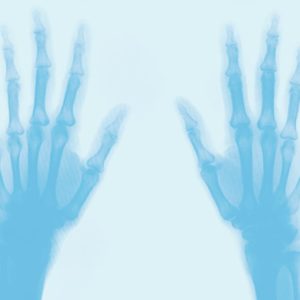 x-ray of hands chattanooga