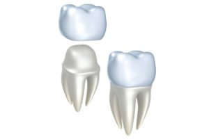 dental crowns chattanooga
