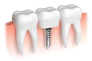 dental implants chattanooga