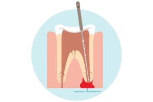 root canals chattanooga