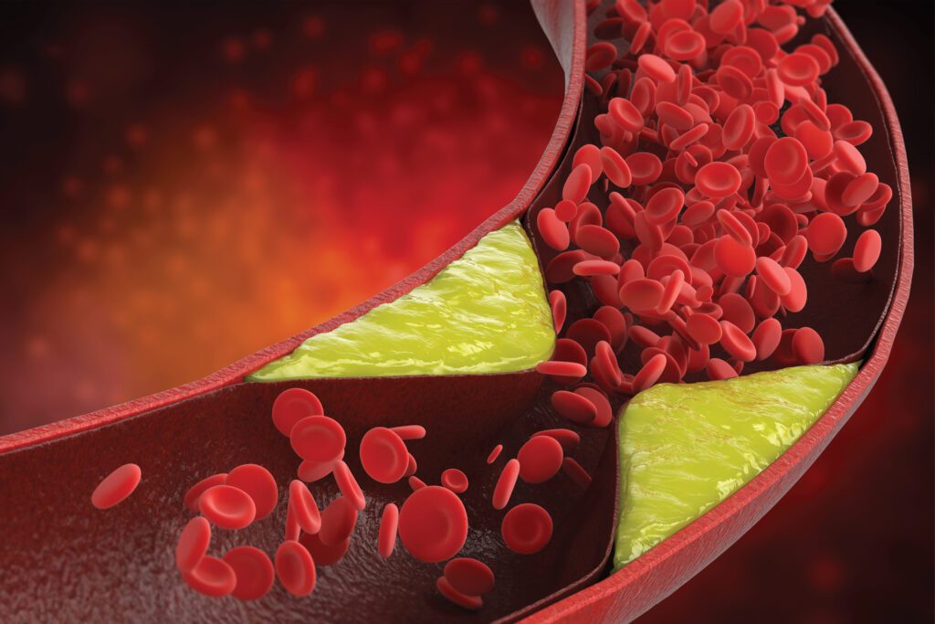 How To Prevent Peripheral Artery Disease