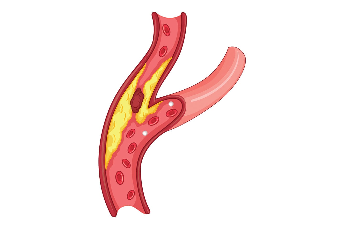vascular health artery disease chattanooga