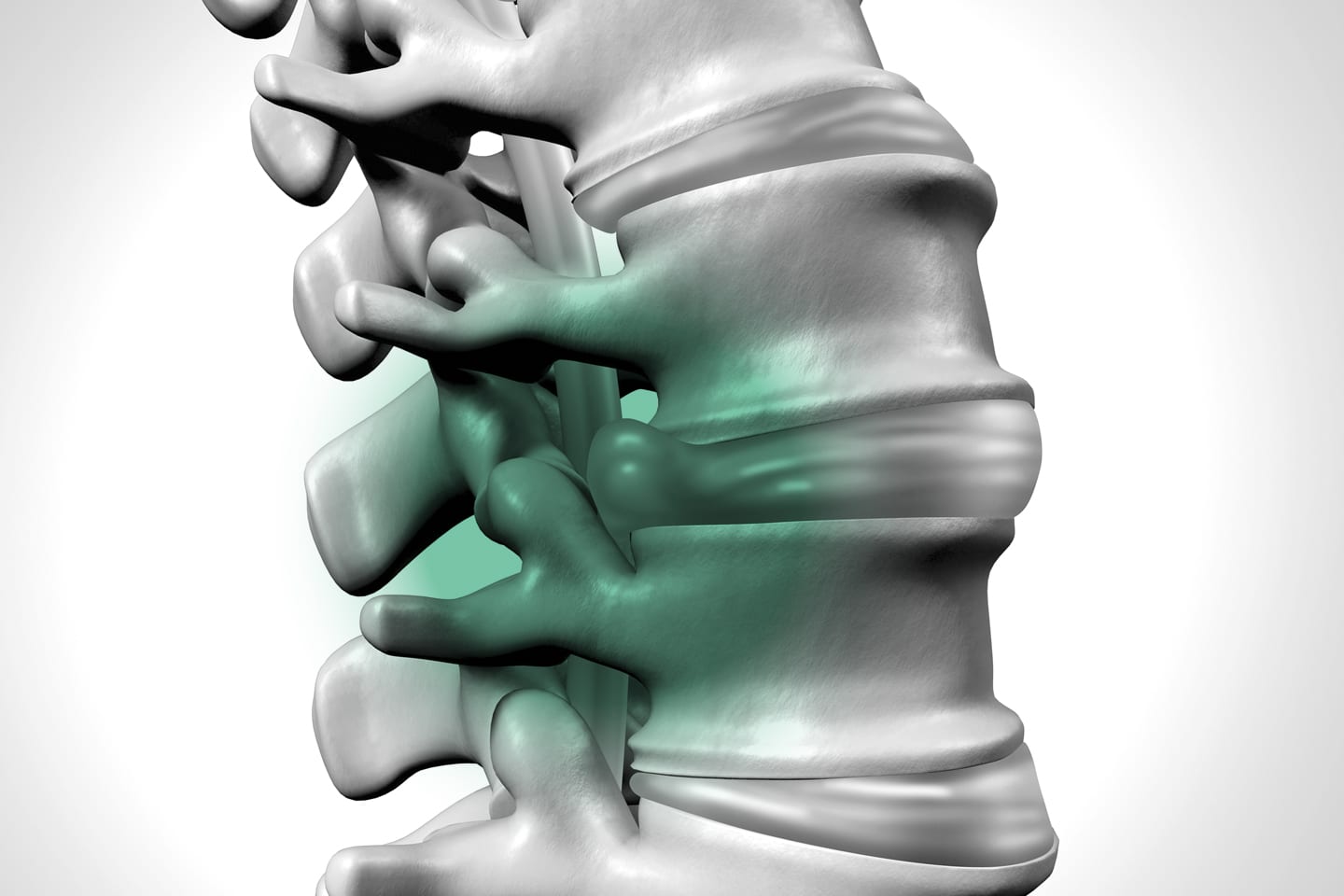herniated disc on a spine