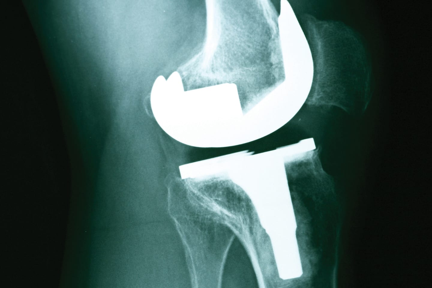 x-ray of a total knee replacement in chattanooga