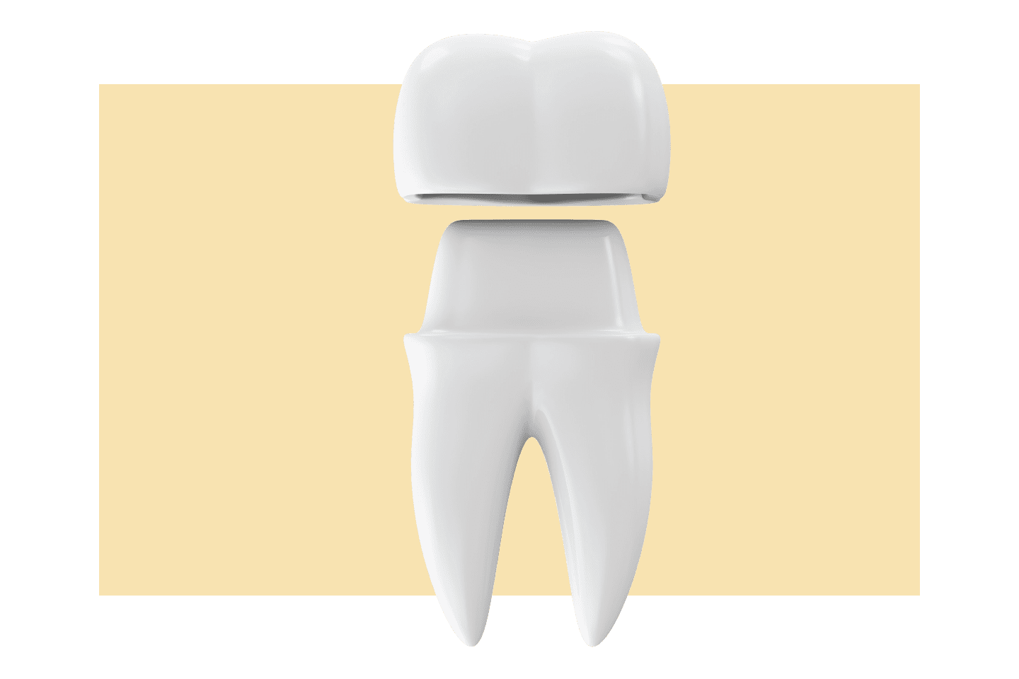 diagram of a dental crown in chattanooga