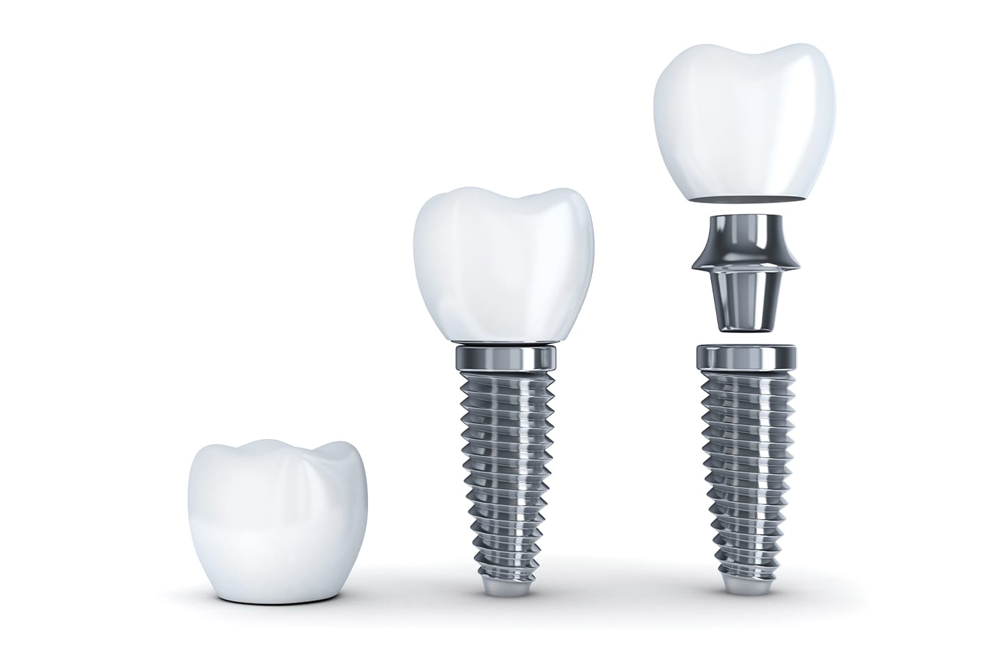 deconstructed dental tooth implants oral health chattanooga