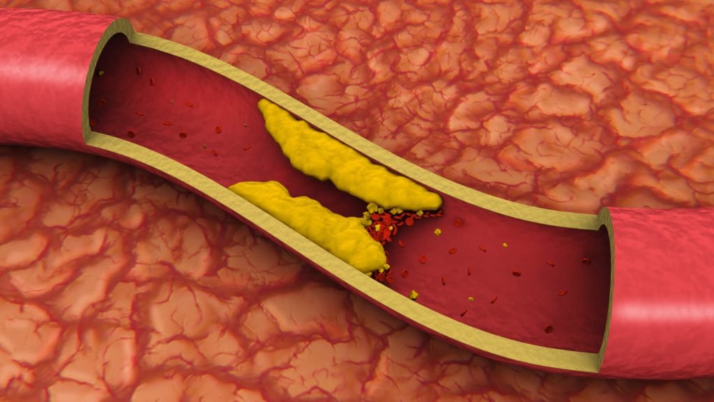 Clogged Artery (3D) showing an example of Deep Vein Thrombosis (DVT)