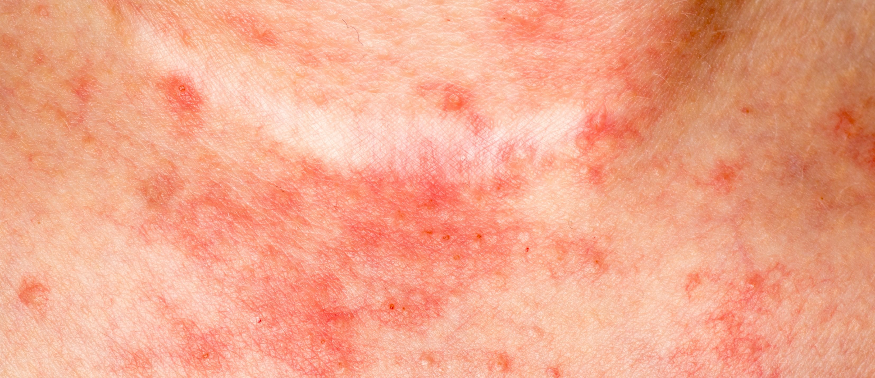 eczema-awareness-for-adults-over-50-the-oldish