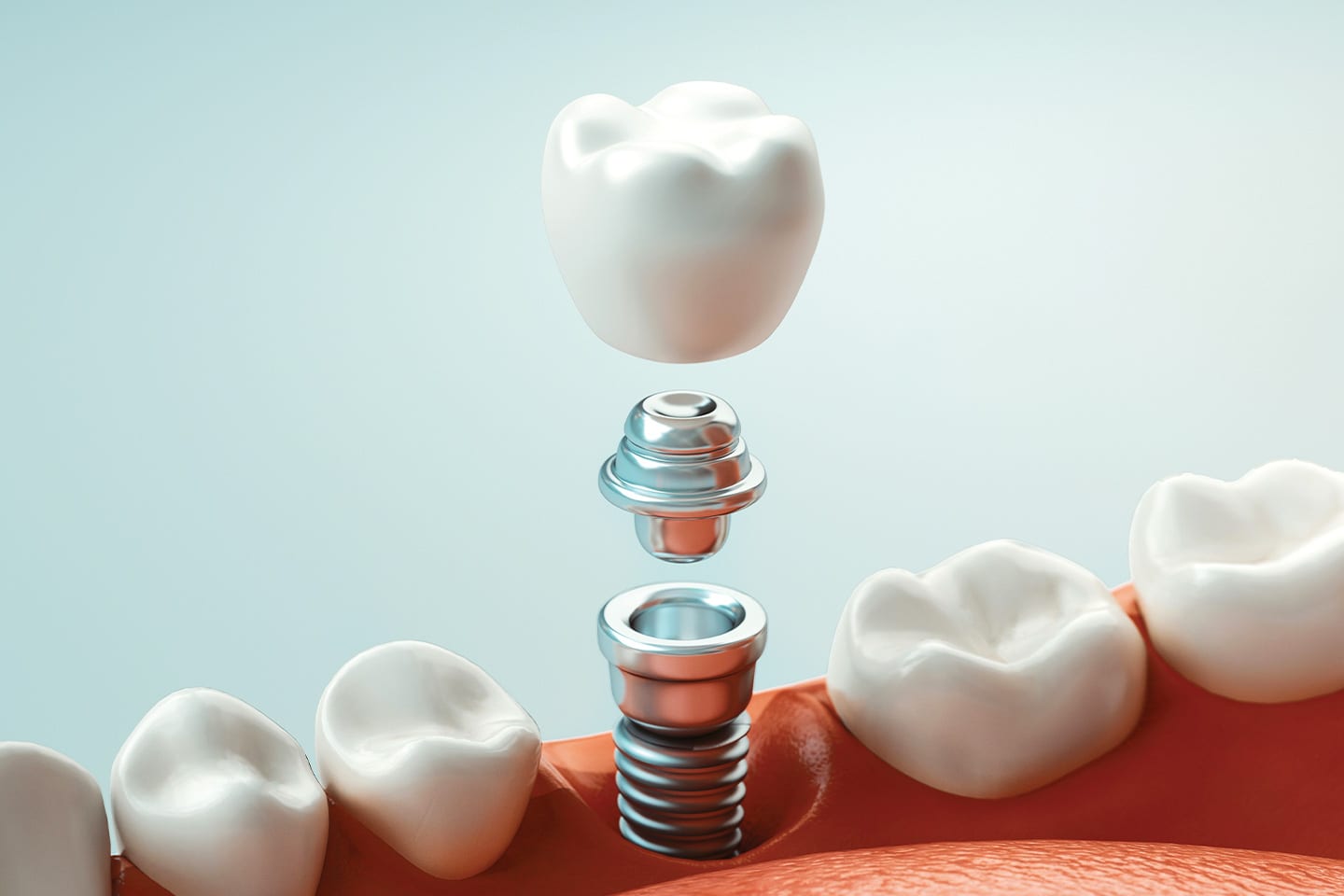 graphic showing the installation of a dental tooth implant
