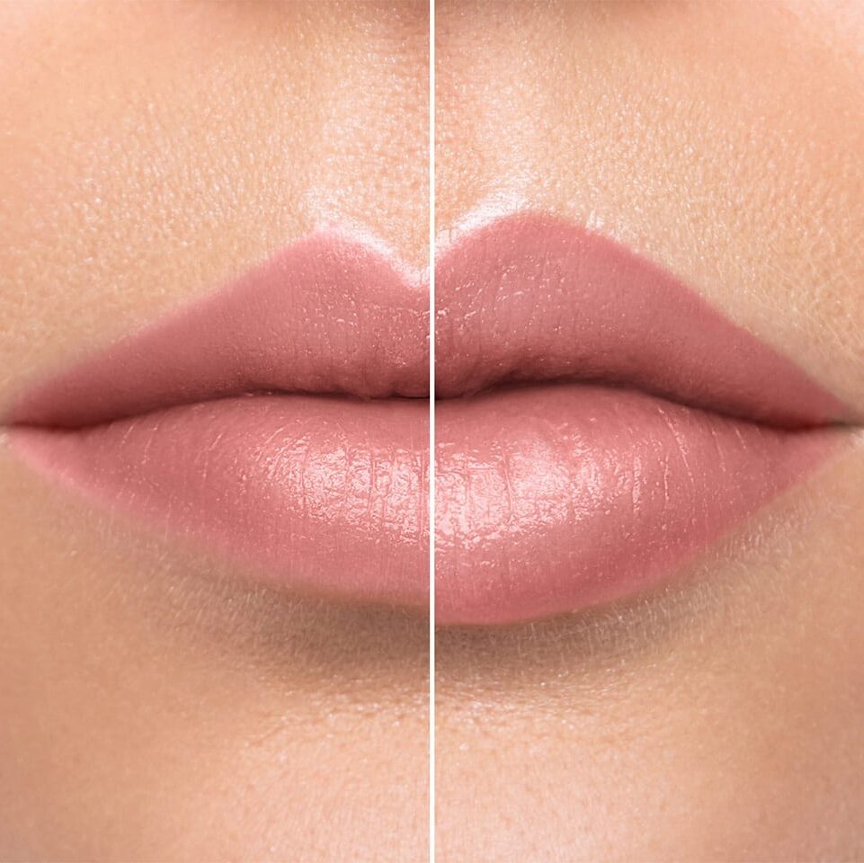 Lip Augmentation before and after picture