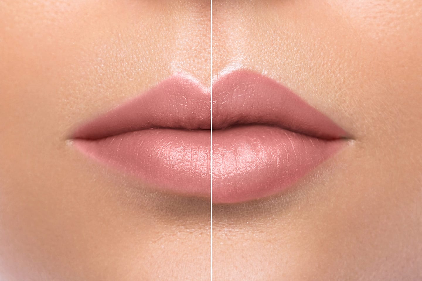 Lip Augmentation before and after picture