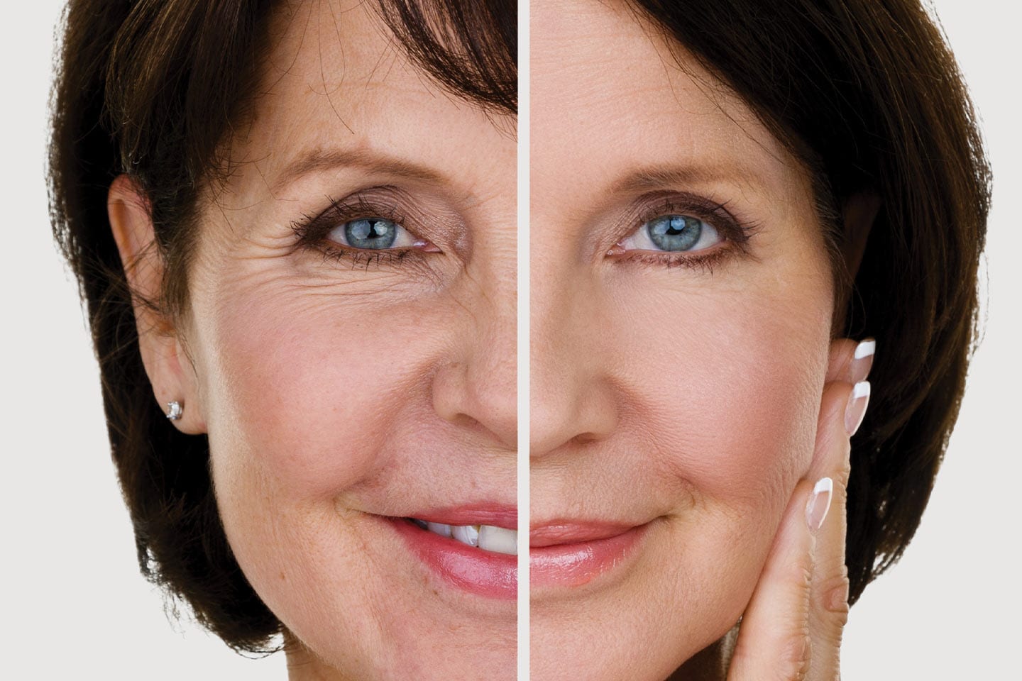 before and after photo of a woman's facelift