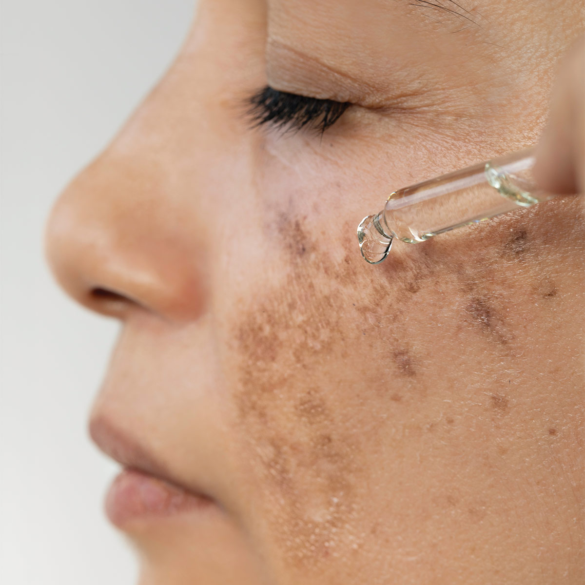 melasma