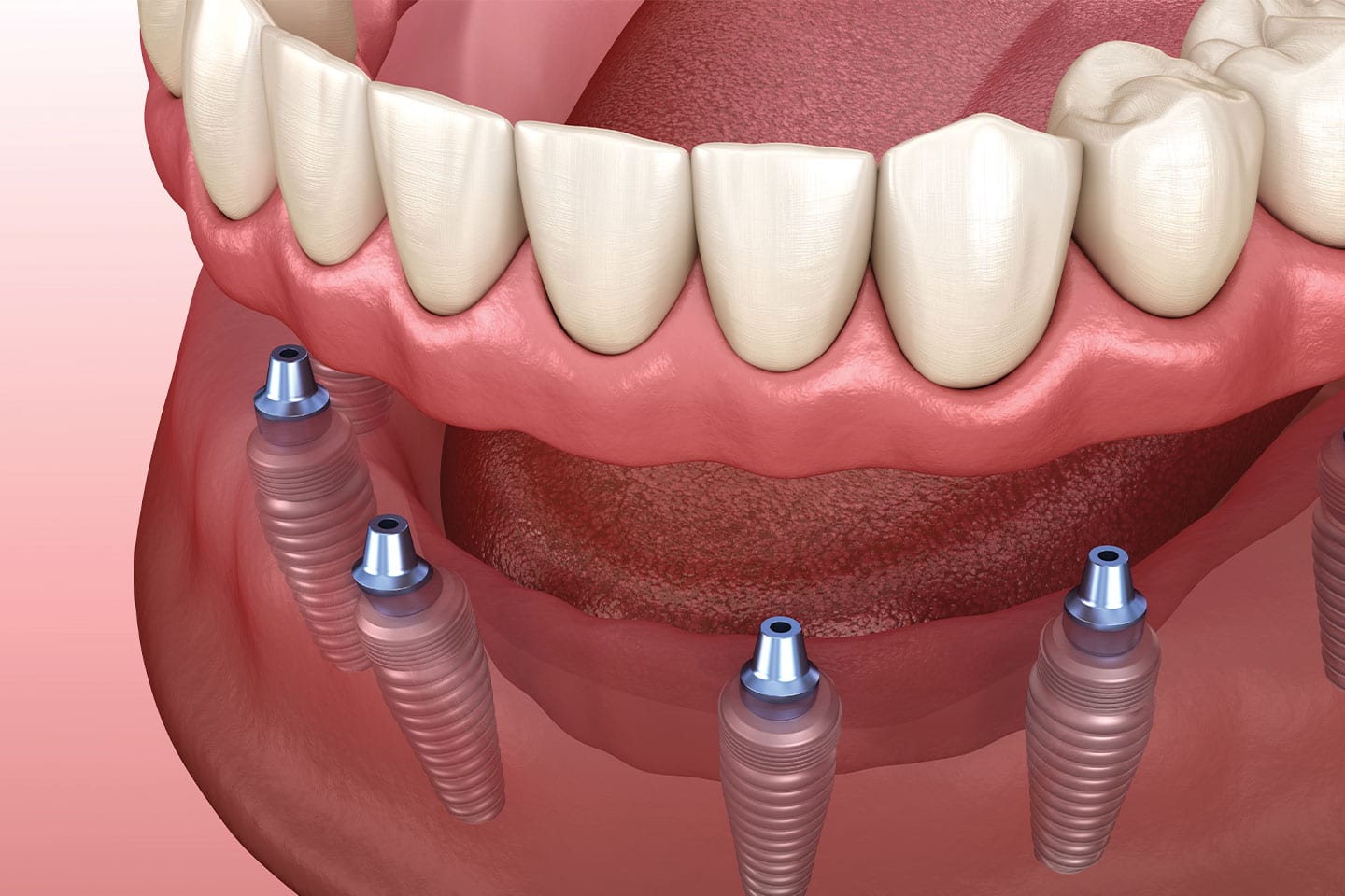 Bridge teeth replacement