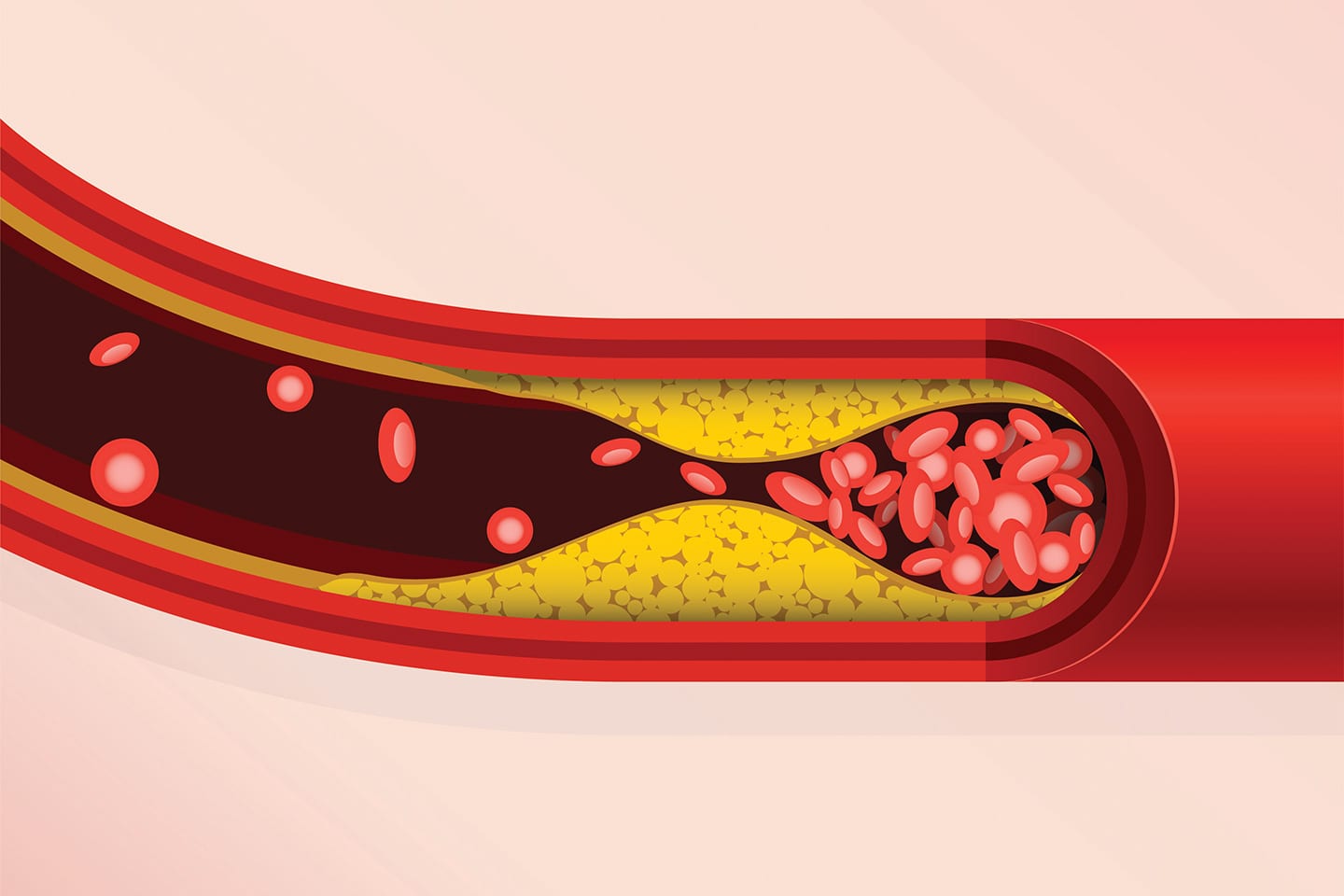 clogged artery illustration