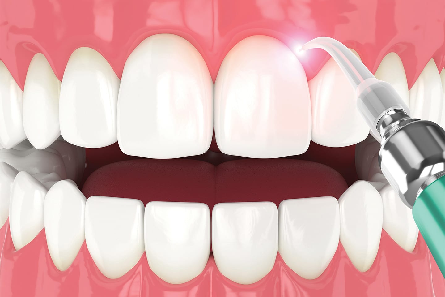 LANAP Laser Treatment being performed on gums