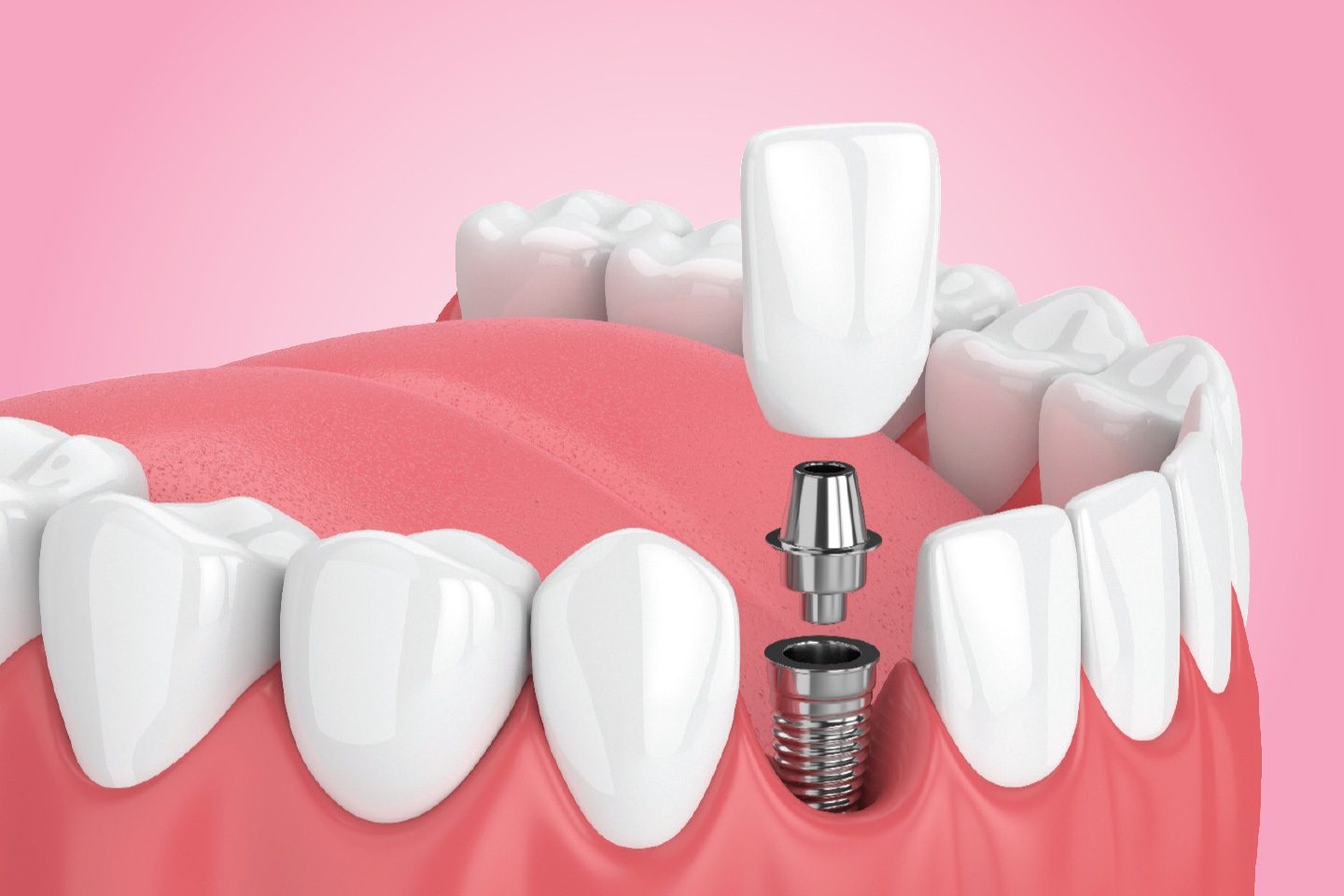rendering of a dental implant in a mouth
