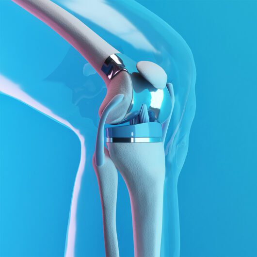 Advancements in Knee Replacement Surgery - HealthScope® Magazine