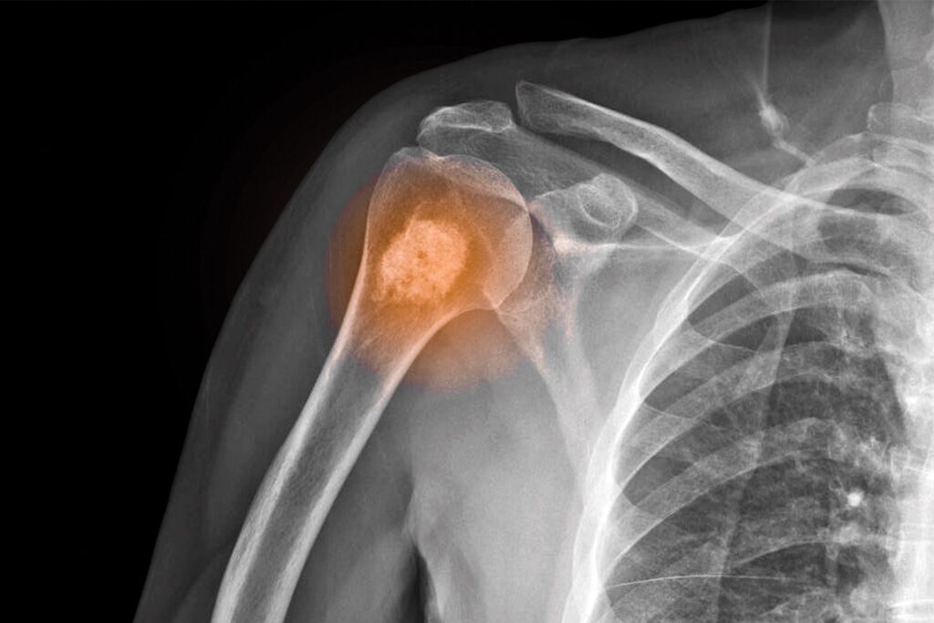 x-ray showing a cancerous tumor in the bone of a person's shoulder