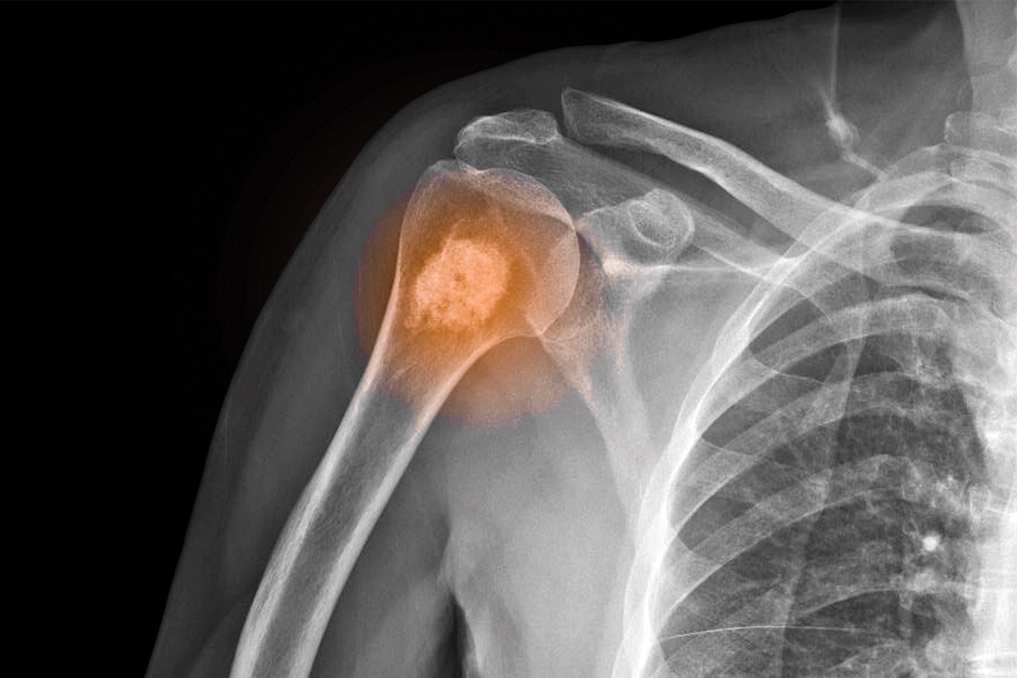 Orthopedic Oncology - HealthScope® Magazine