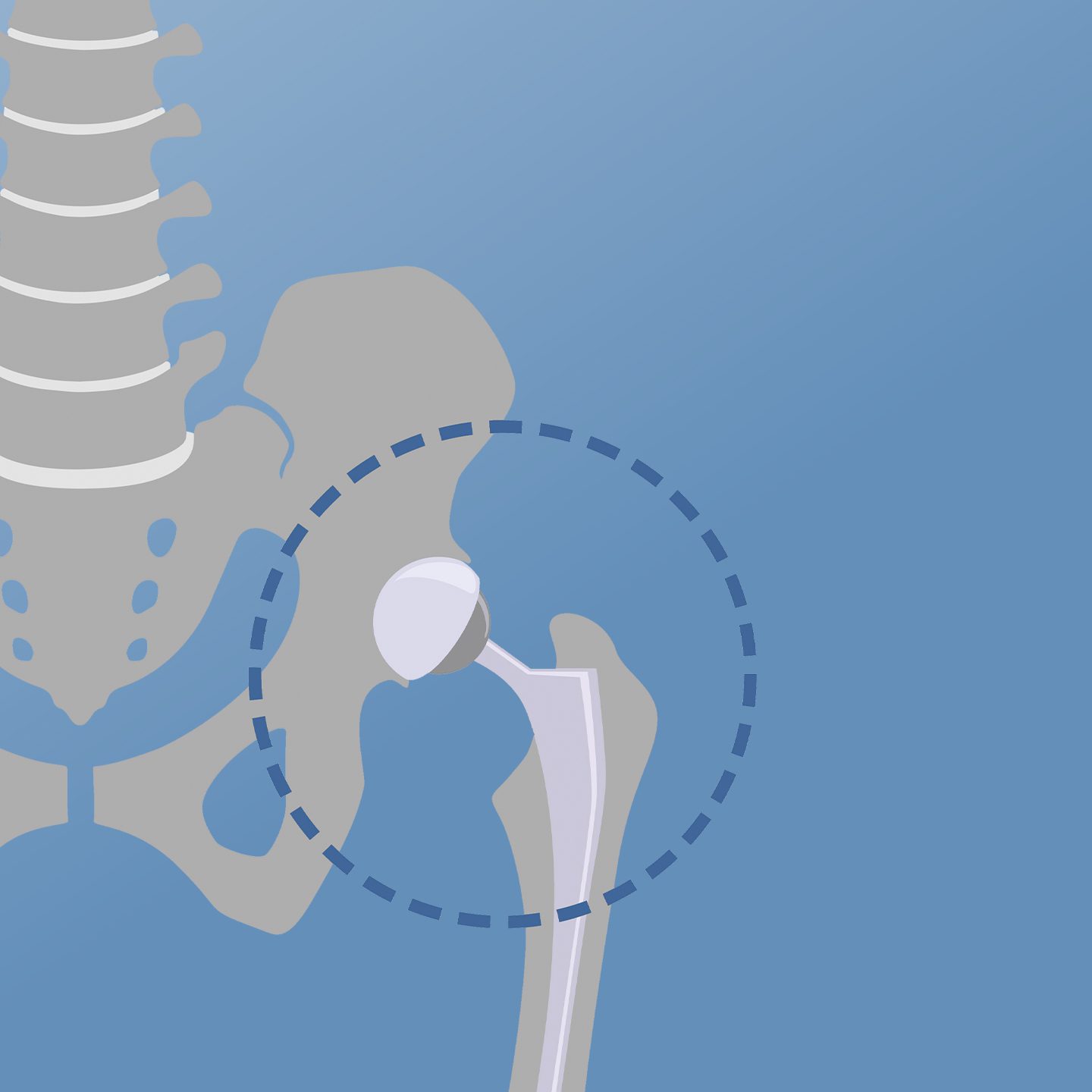 Anterior Approach Hip Replacement - HealthScope® Magazine