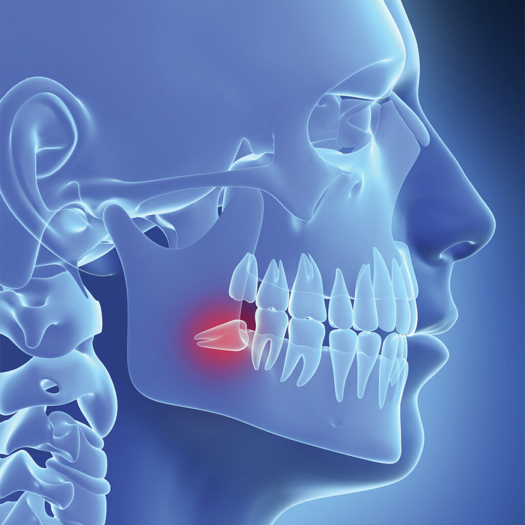 illustration of wisdom teeth needed to be extracted deep within the back gums