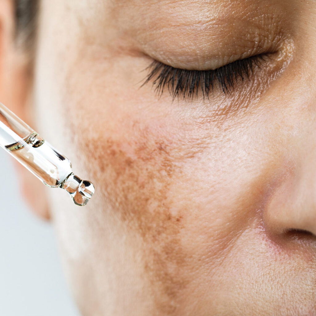 applying serum to woman's face with sun spots