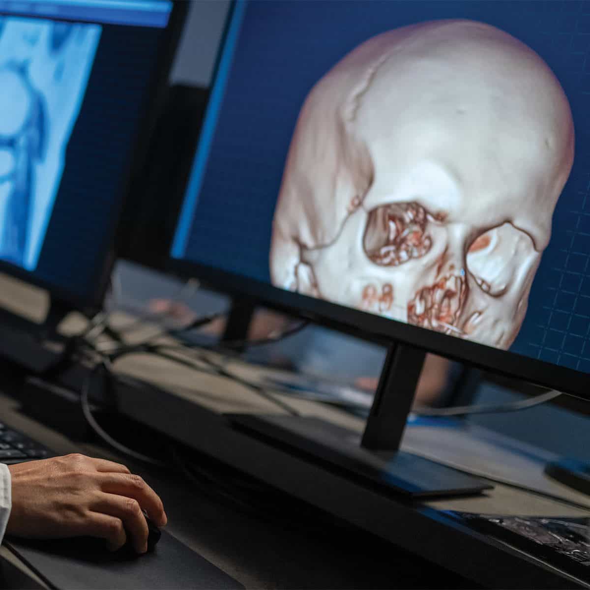 craniofacial surgery | surgeon looking at 3D skull in computer