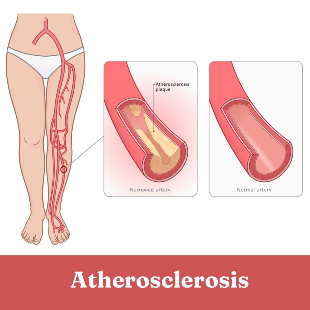 Peripheral Vascular Disease