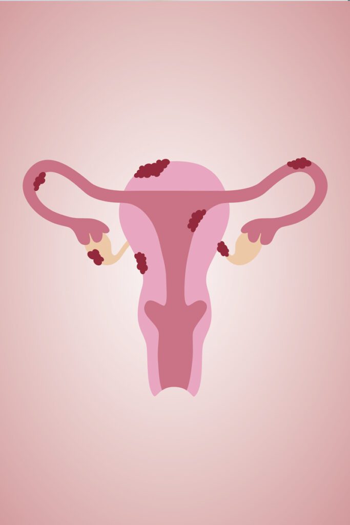 uterus with endometriosis