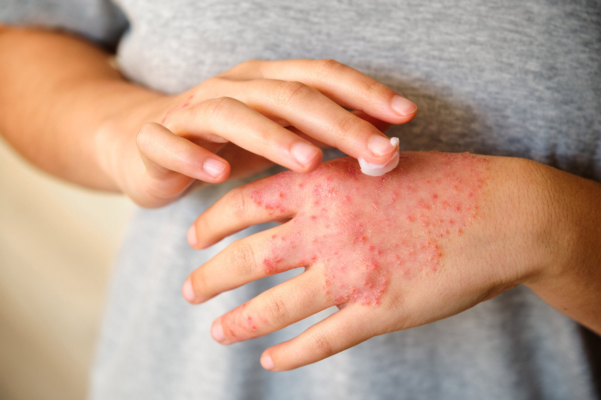 hand with eczema rubbing creme on it
