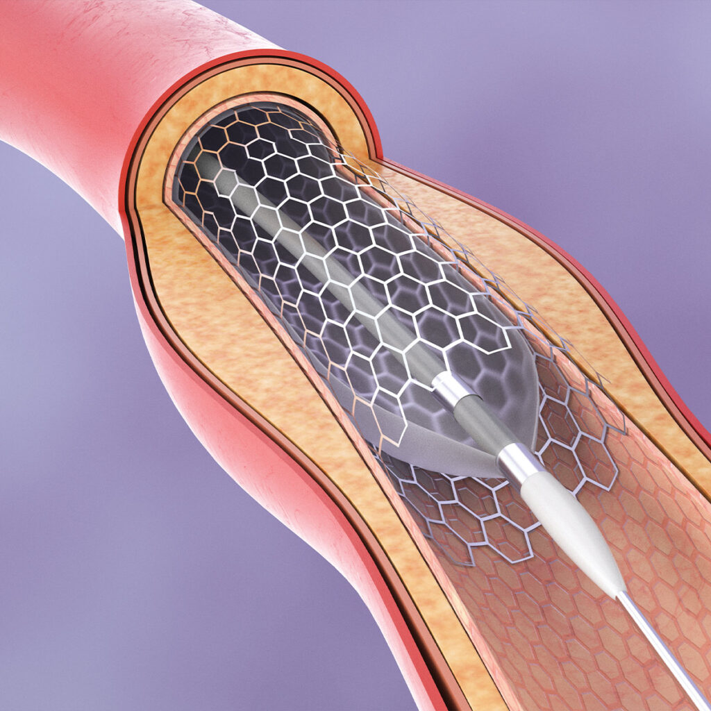 Transcarotid Artery Revascularization