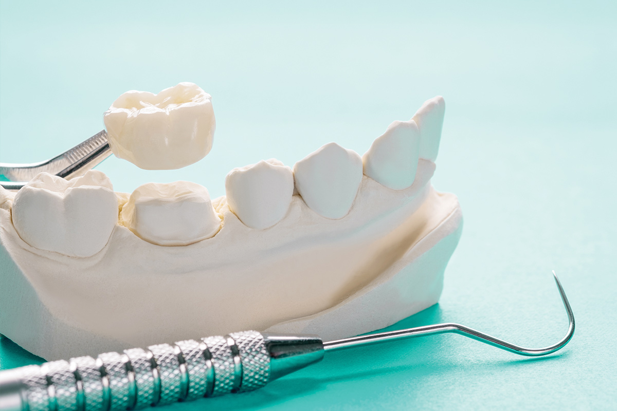 CEREC Same Day Crowns