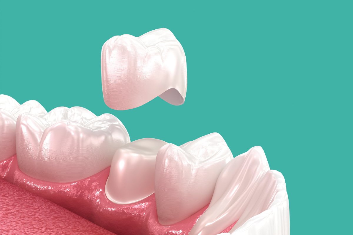 A dental crown hovering above a pink gum line, set against a teal background.