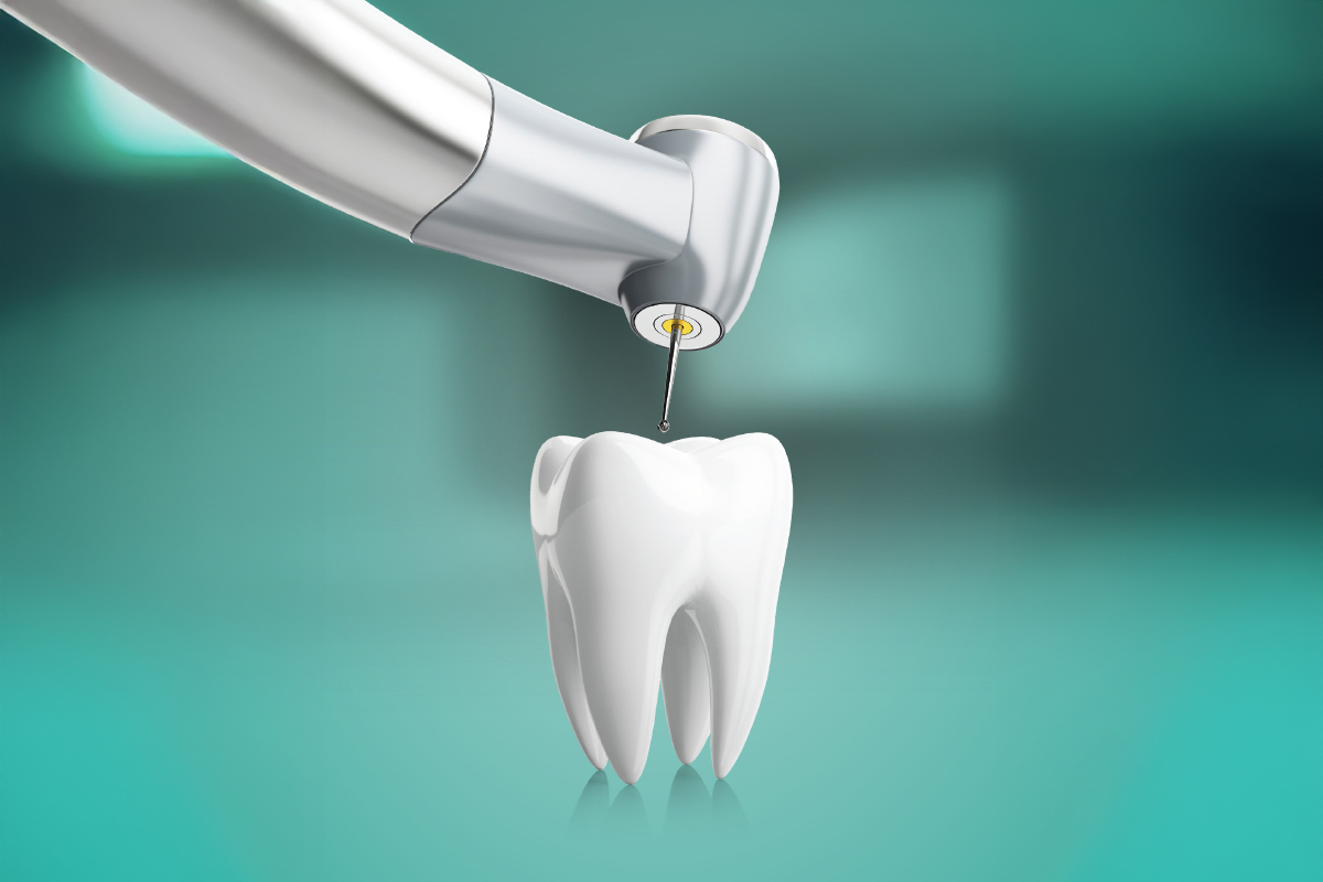 illustration of a root canal