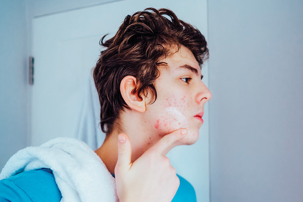 A young man with curly hair examines his face, applying skincare on acne-affected skin in a well-lit bathroom.