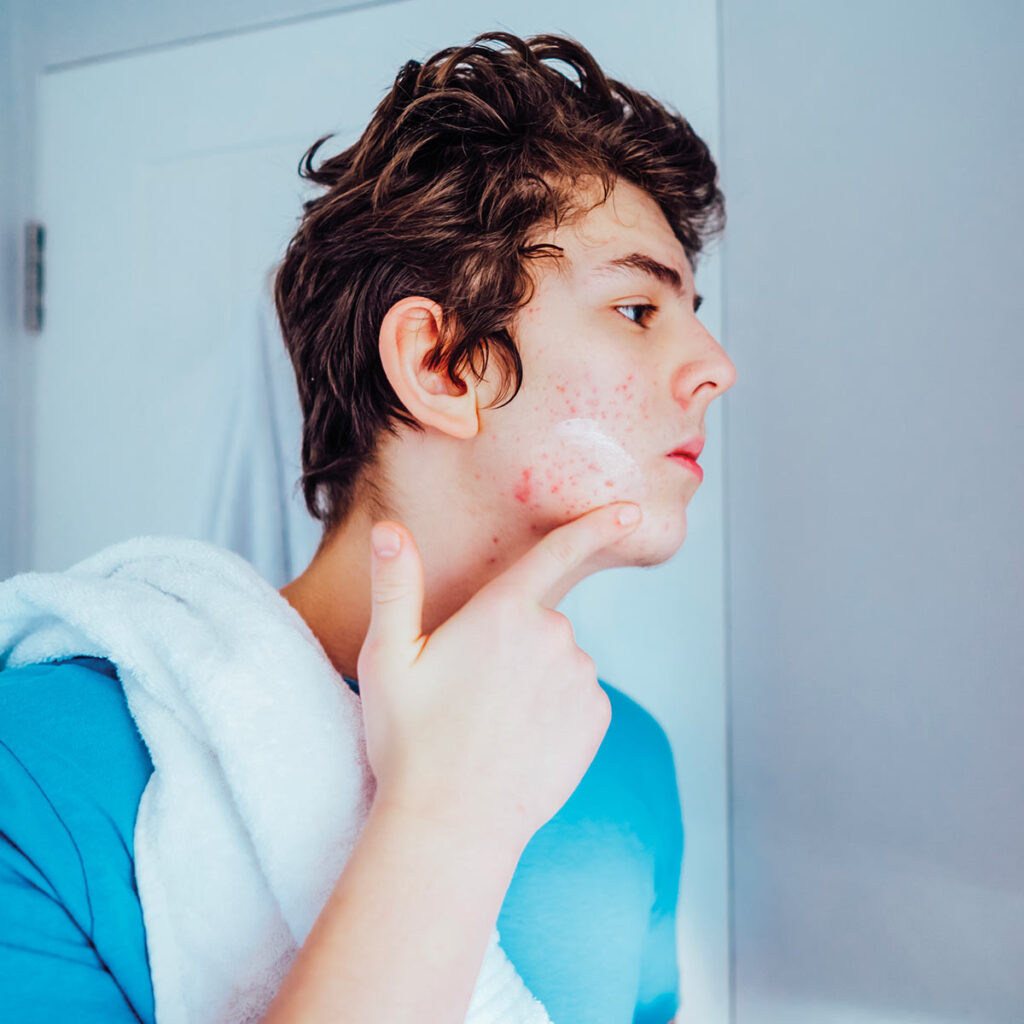 A young man with curly hair examines his face, applying skincare on acne-affected skin in a well-lit bathroom.