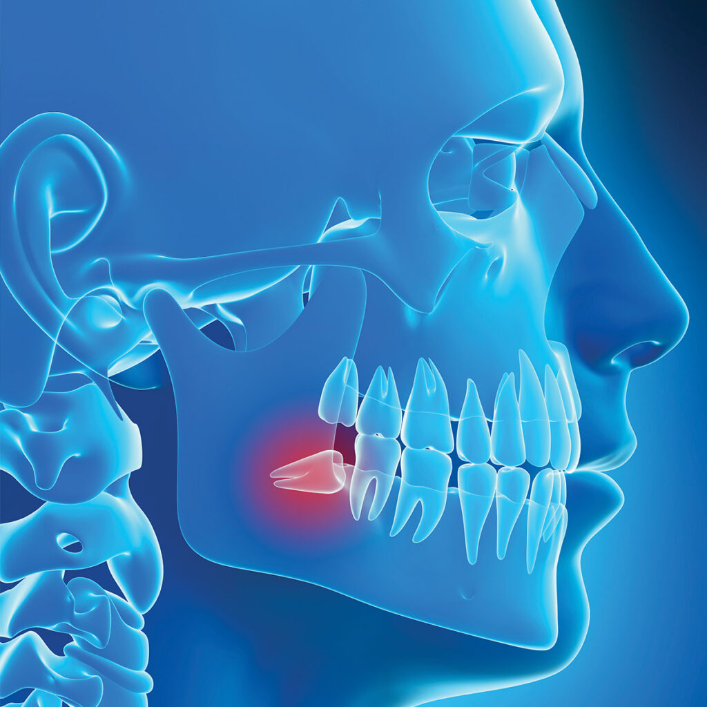 Illustration of a human skull highlighting the lower jaw and a red area indicating a tooth, set against a blue background.