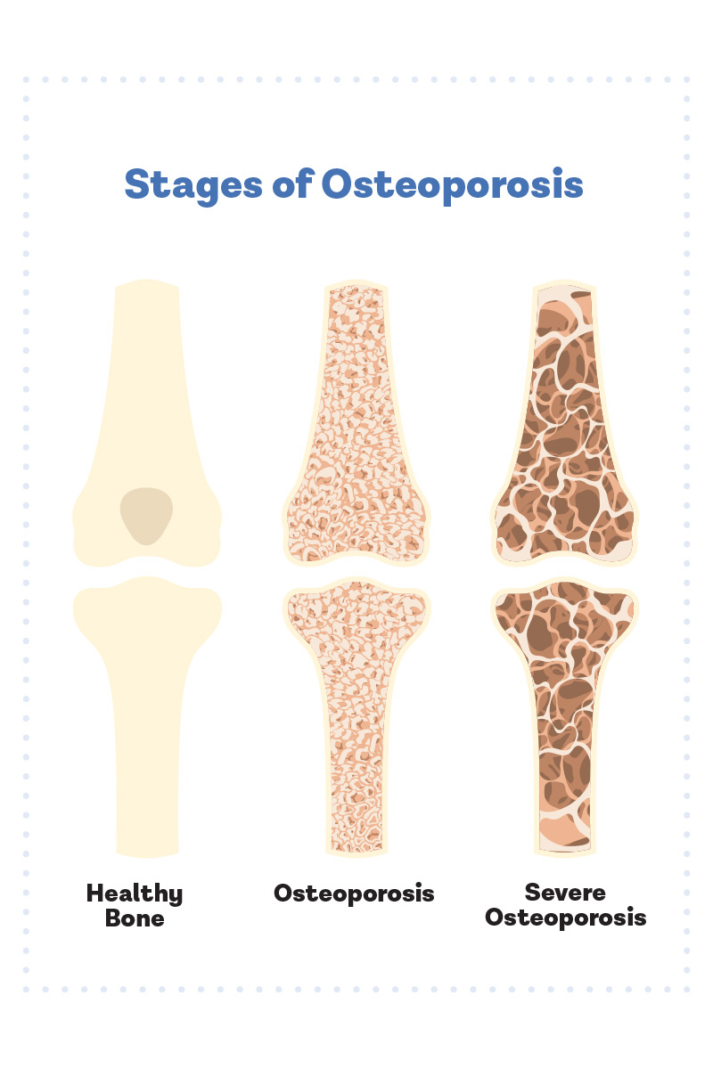 Stages of Osteoporosis Graphic