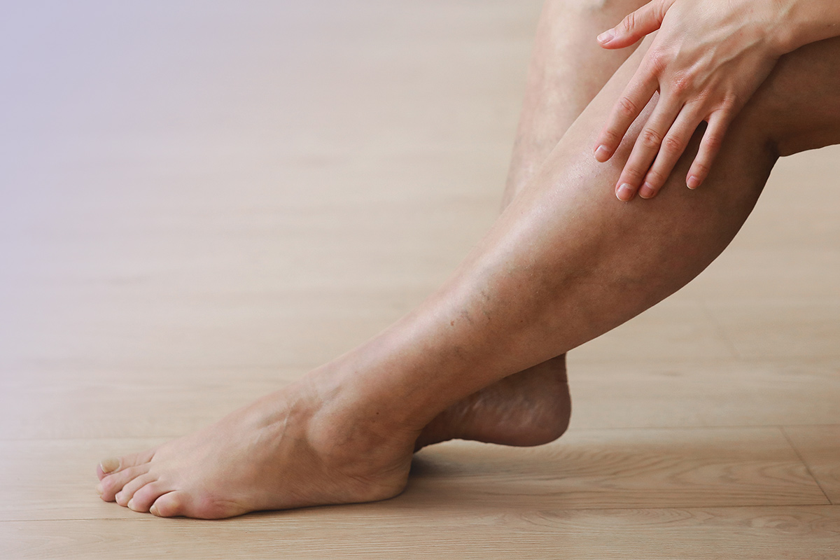 womans legs with veins
